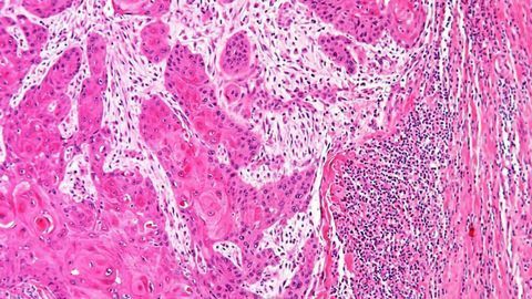 Drug Could Improve Cancer Immunotherapy Success