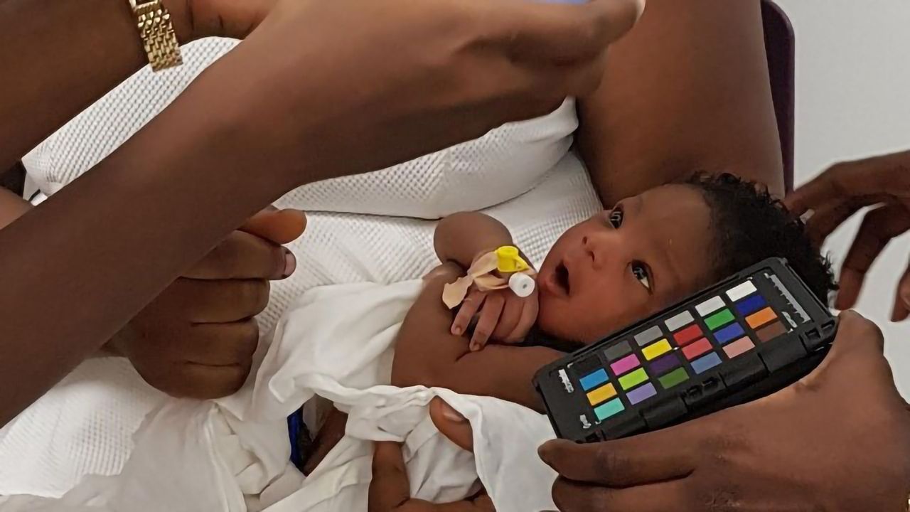 App Can Detect Jaundice in Newborns