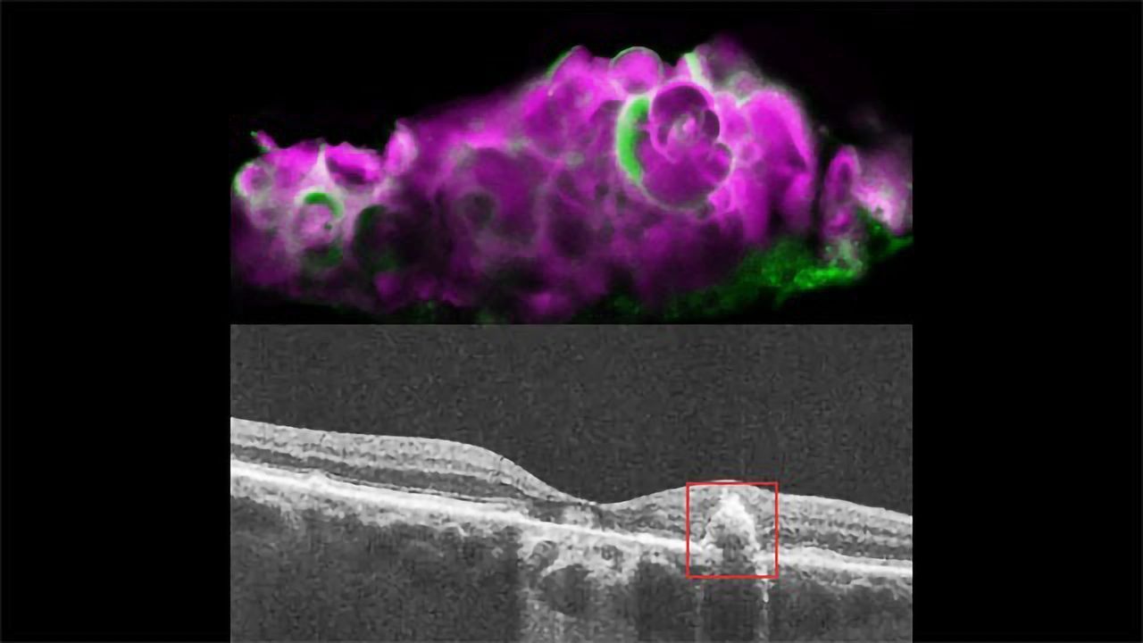 Tooth-enamel Protein Implicated in Eye Disease
