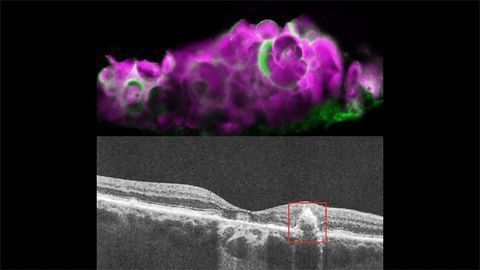 Tooth-enamel Protein Implicated in Eye Disease