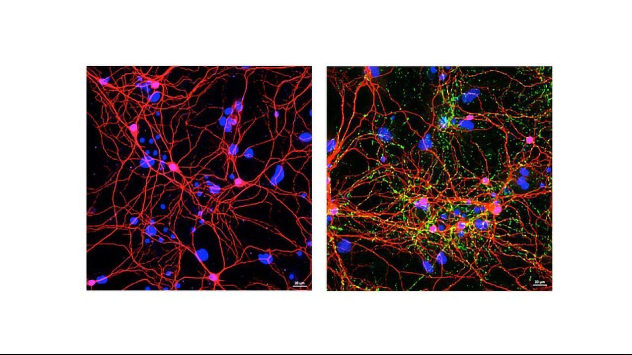 Turning the Body's "Natural Killers" Against Parkinson's Disease