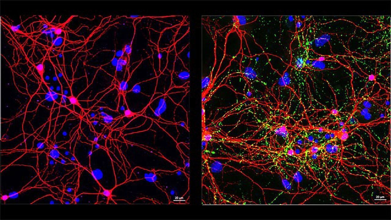 Neurons: Healthy vs. Parkinson’s Disease