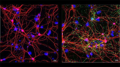 Neurons: Healthy vs. Parkinson’s Disease