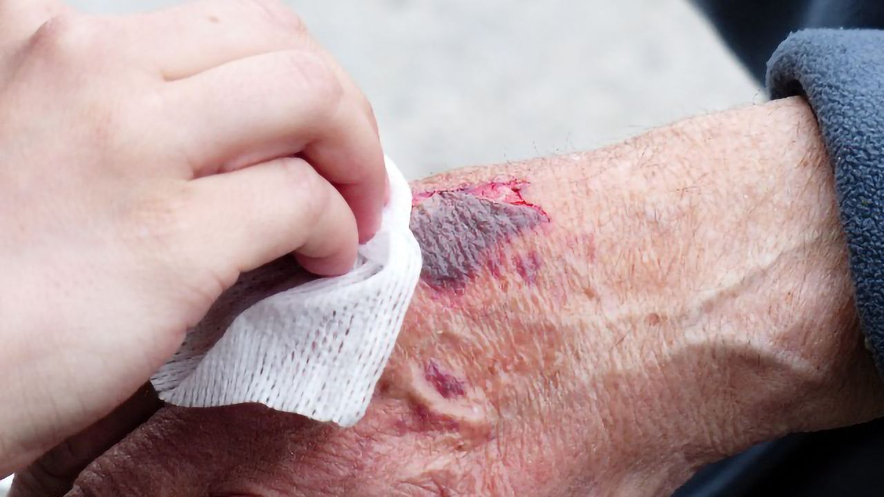 How Skin Cells Prepare To Heal Wounds