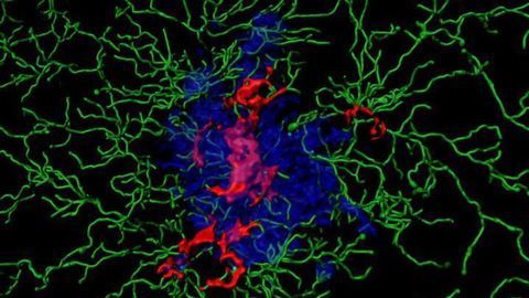 Immune Reaction Is "Fuel to the Fire" of Alzheimer's Disease