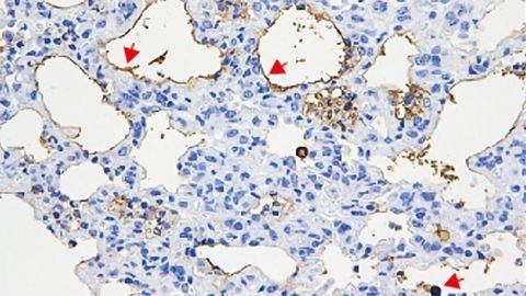 Lung Cells Killed by Bacterial Protein Fragments