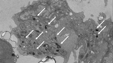 Age of Immune Cells May Play a Role in Immunotherapy Effectiveness