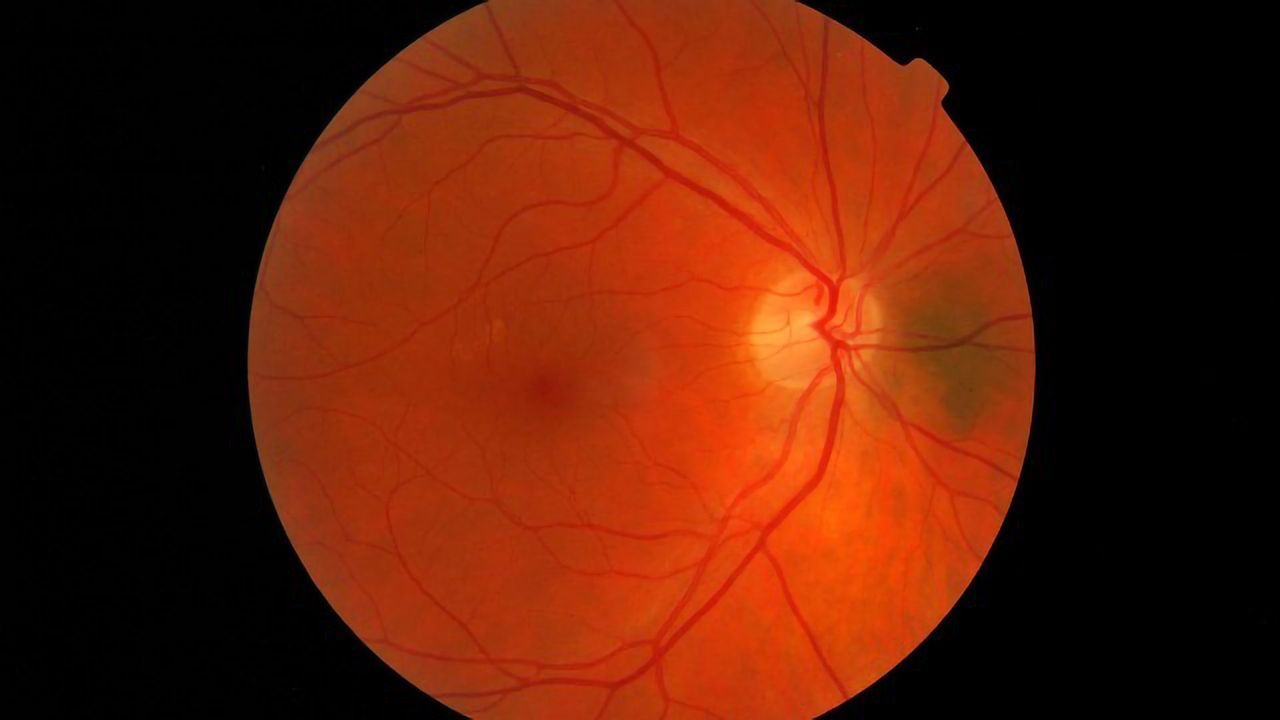 Advances in Production of Retinal Cells for Treating Blindness