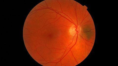 Advances in Production of Retinal Cells for Treating Blindness