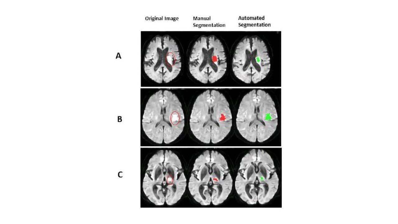 AI Analysis Could Accelerate Stroke Detection