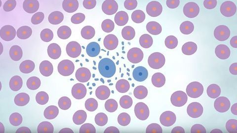 What Is Philadelphia Positive Leukemia?
