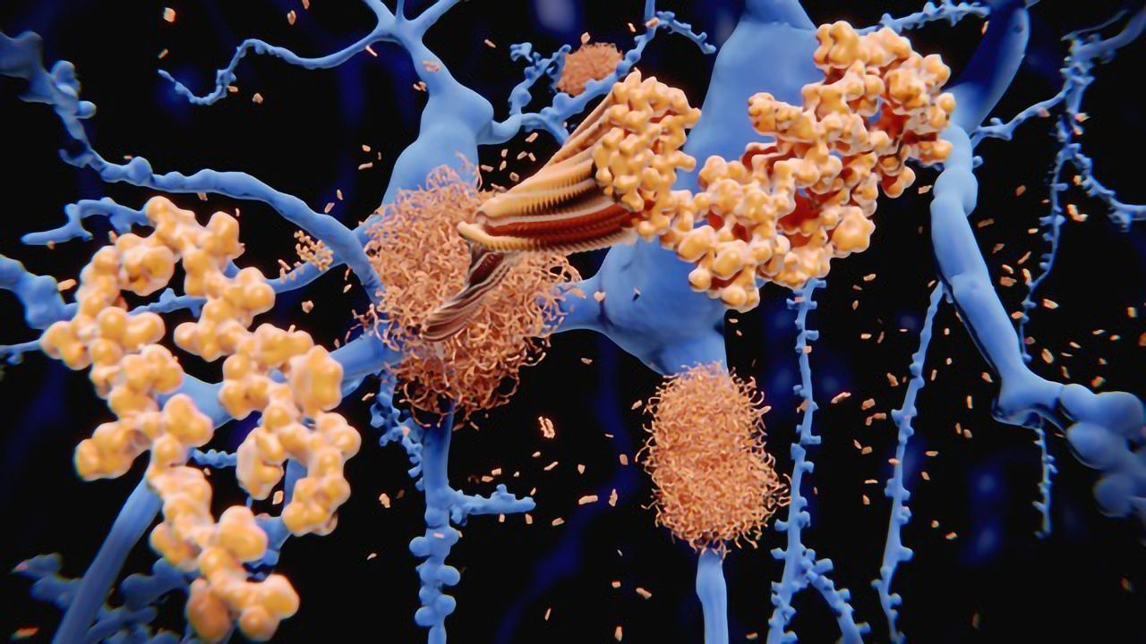 Increased Amyloid Marks Out Healthy People at Risk of Alzheimer's