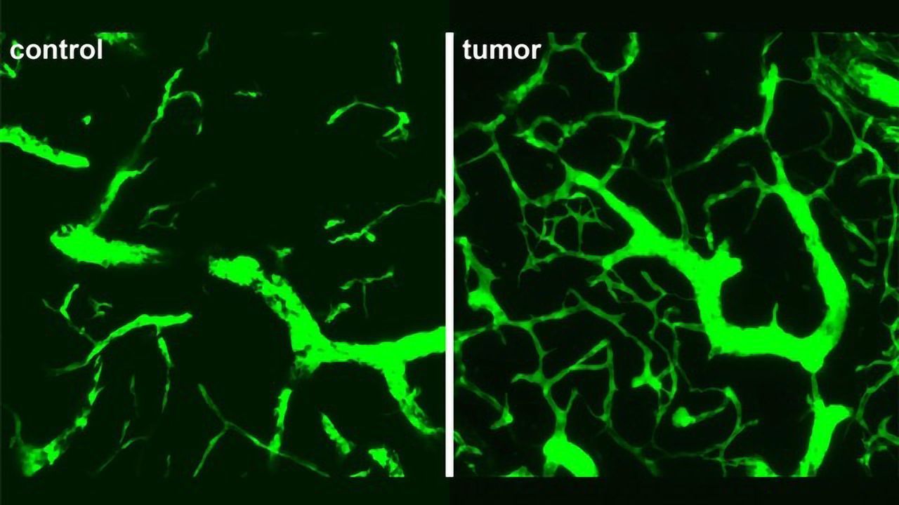 A Potential Drug Target To Slow Lymphoma Tumor Growth