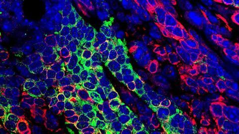 Tailoring Treatment for Triple-negative Breast Cancer