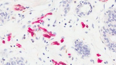 Exploring the Possible Mechanism Linking Obesity and Breast Cancer