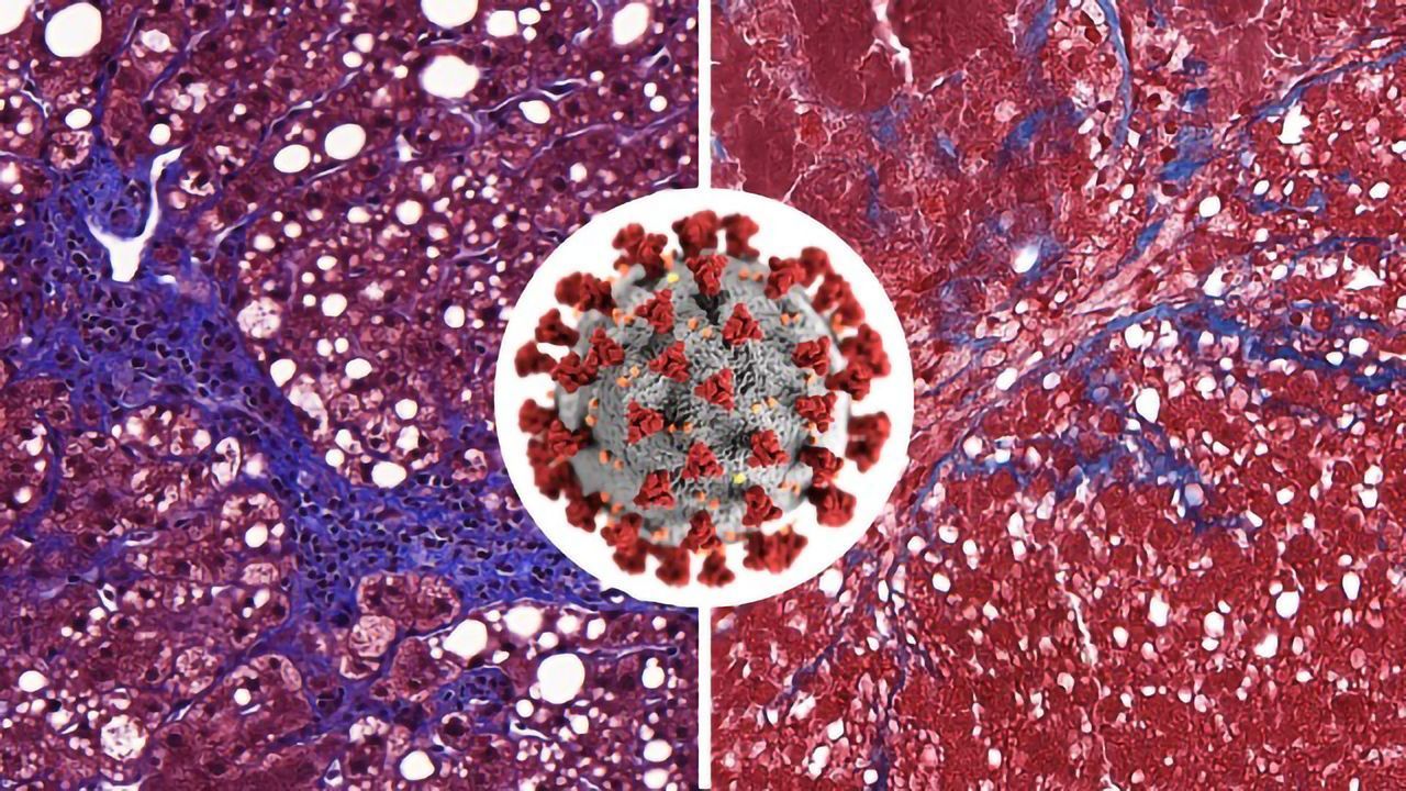 Using Bioprinted Tissue Models To Test Drugs Against Diseases Including COVID-19