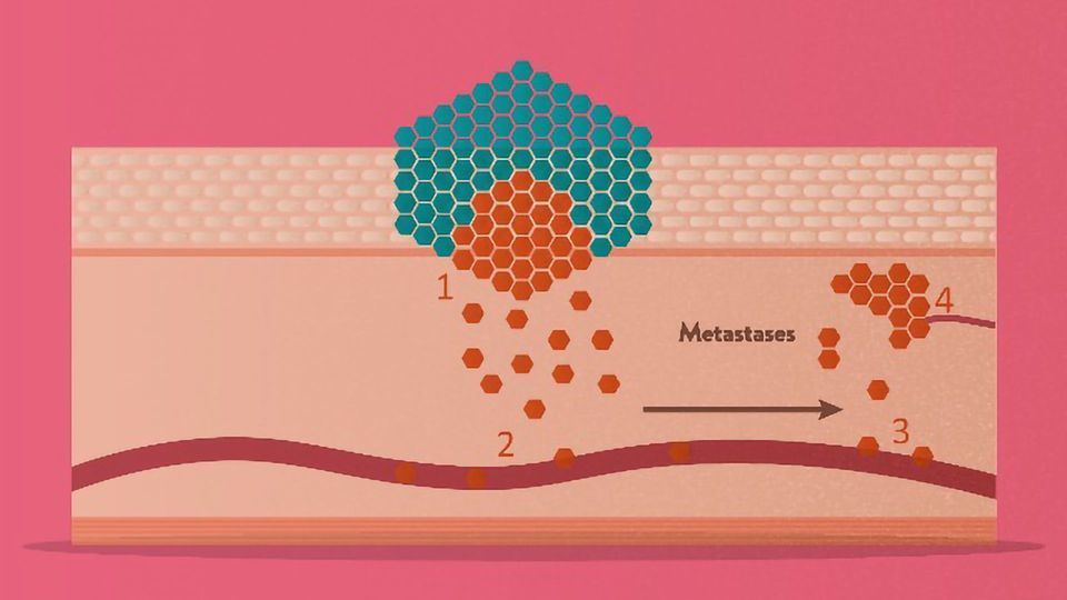 The stages of metastasis.