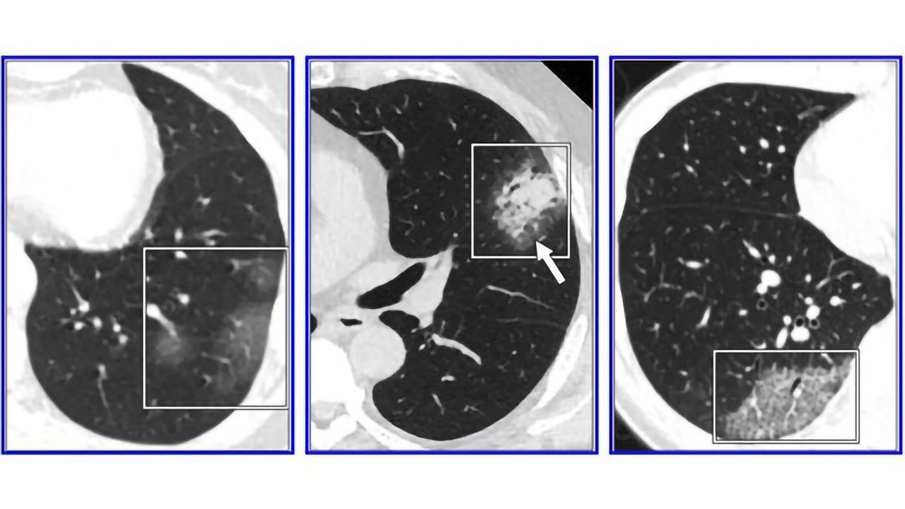 Review Cautions Against Chest CT for Coronavirus Diagnosis