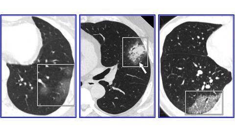 Review Cautions Against Chest CT for Coronavirus Diagnosis