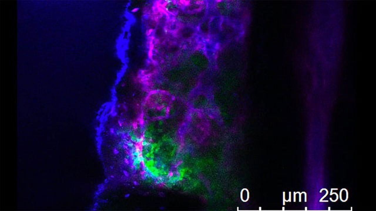 Leukemia Cells in Bone Marrow