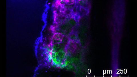 Leukemia Cells in Bone Marrow