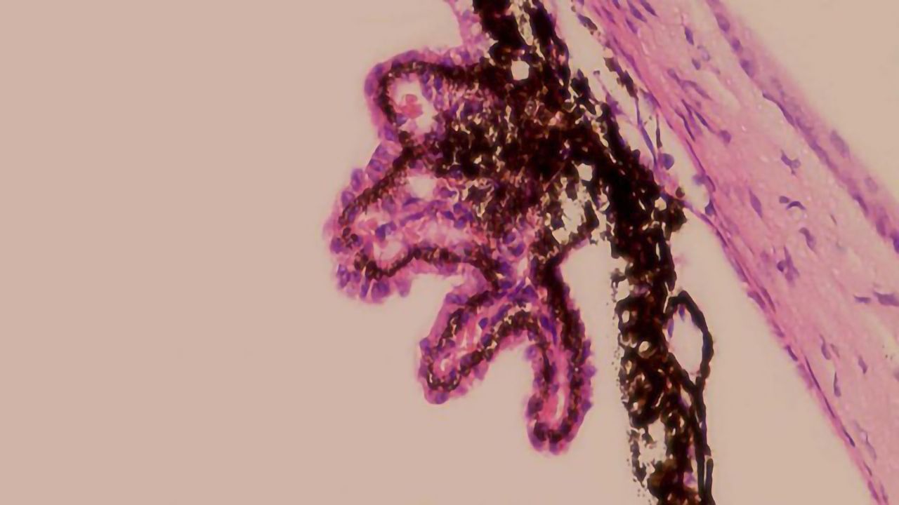 Glaucoma Could Be Successfully Treated With Gene Therapy