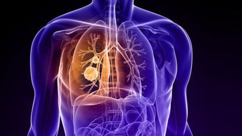 Guidance on Lung Cancer Screening and Management During COVID-19 Issued