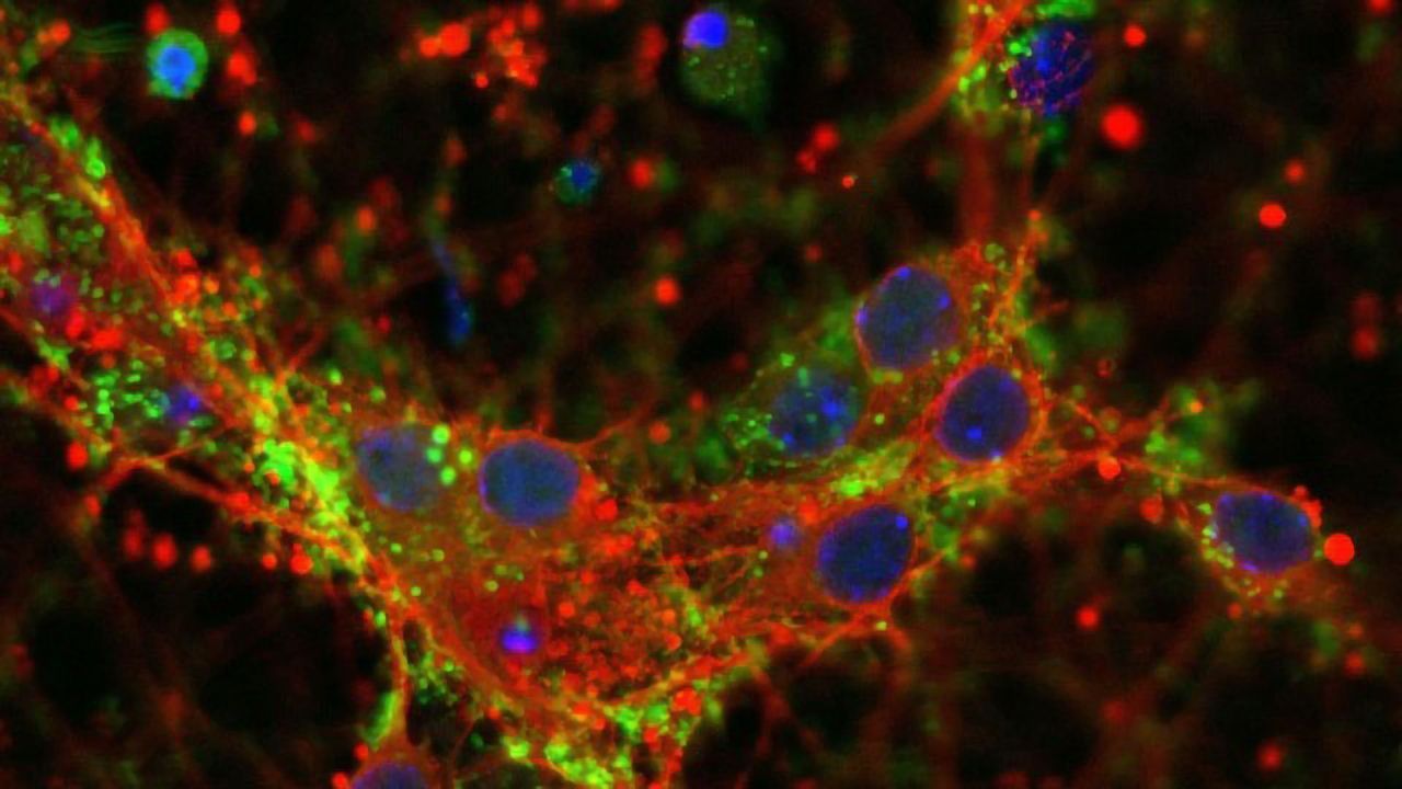 Protein Mystery of Three Brain Diseases Unraveled