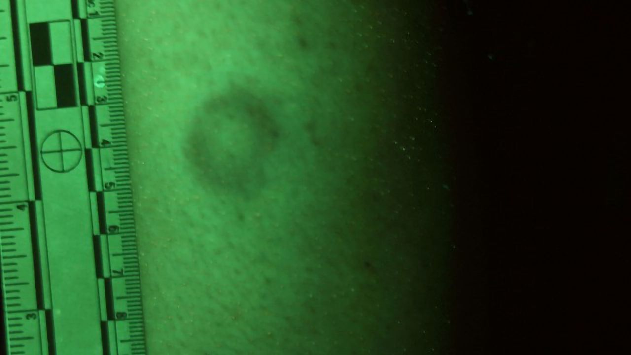 Detecting Bruises on Victims of Color Five Times More Effective Using Alternate Light