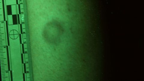 Detecting Bruises on Victims of Color Five Times More Effective Using Alternate Light