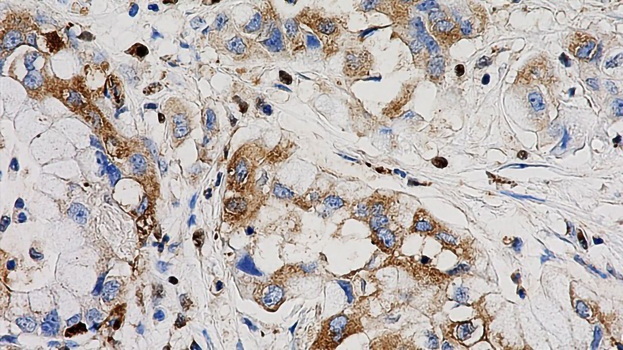 Halting Pancreatic Cancer Growth by Activating Estrogen Receptor on Cell Surface