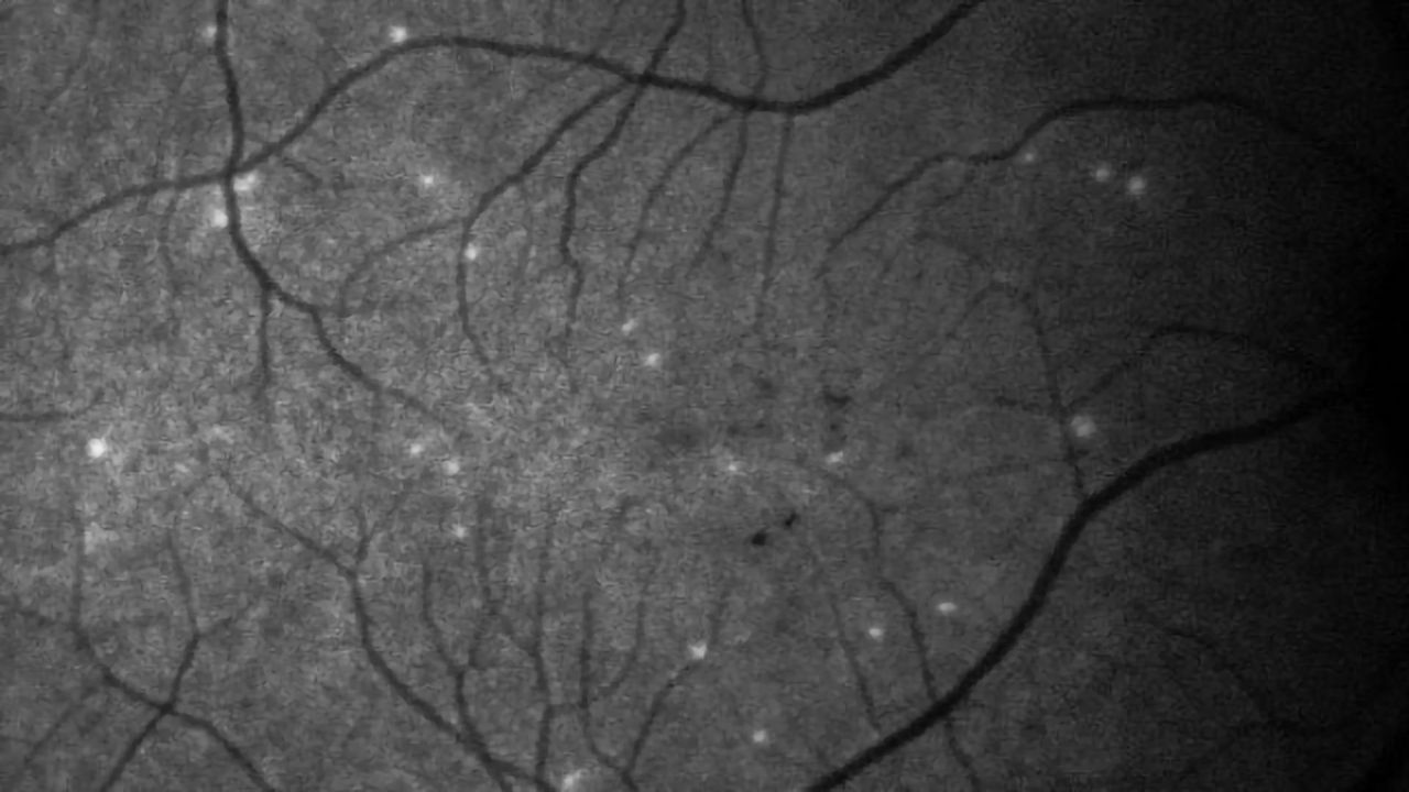 New Test Detects Glaucoma Progression Earlier