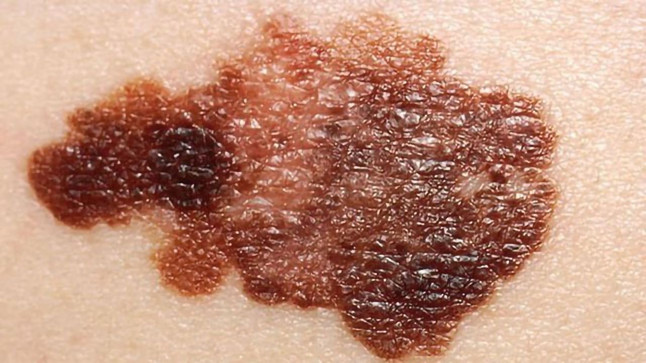 New Genetic Regions Linked to Risk of Melanoma