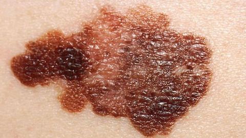 New Genetic Regions Linked to Risk of Melanoma