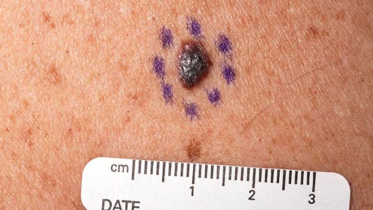 Patients With Malignant Melanoma May Benefit From Antihistamines