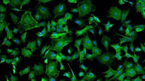 Four of Six COVID-19 Patients Improved After Heart Cell Therapy