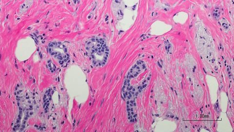 Immune Cell Alterations Could Aid Breast Cancer Detection