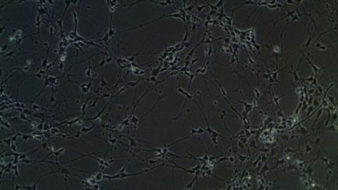 Group of Genes Have Altered Expression in Autism