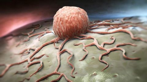 Mathematical Model Developed To Predict Prostate Cancer Aggressiveness