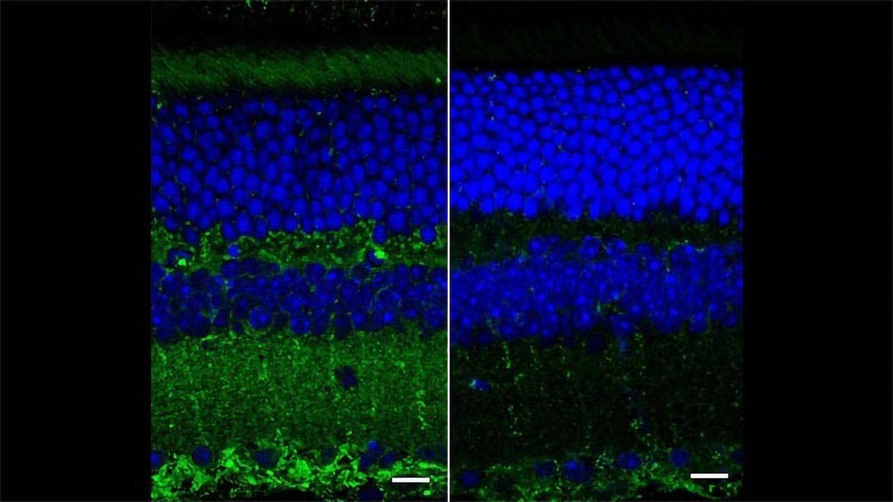 Retinal Texture: An Alzheimer’s Biomarker?