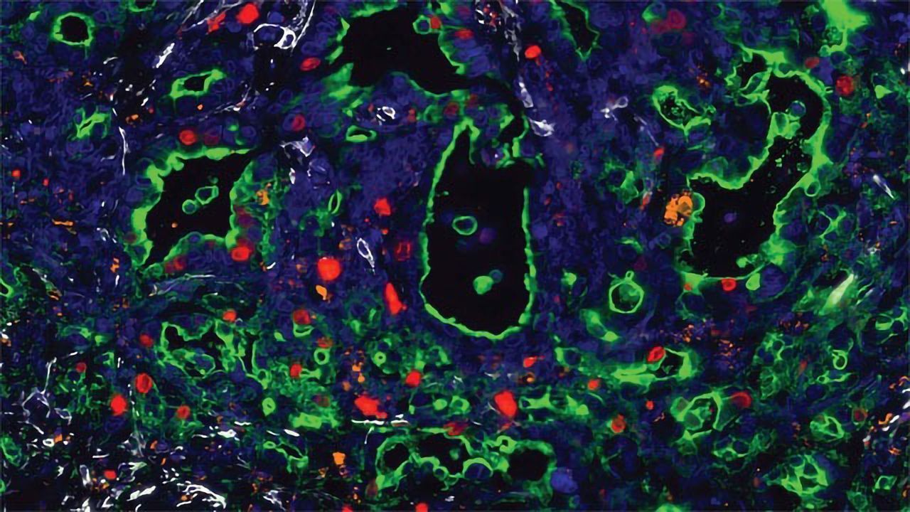 Human Pancreatic Cancer Cells