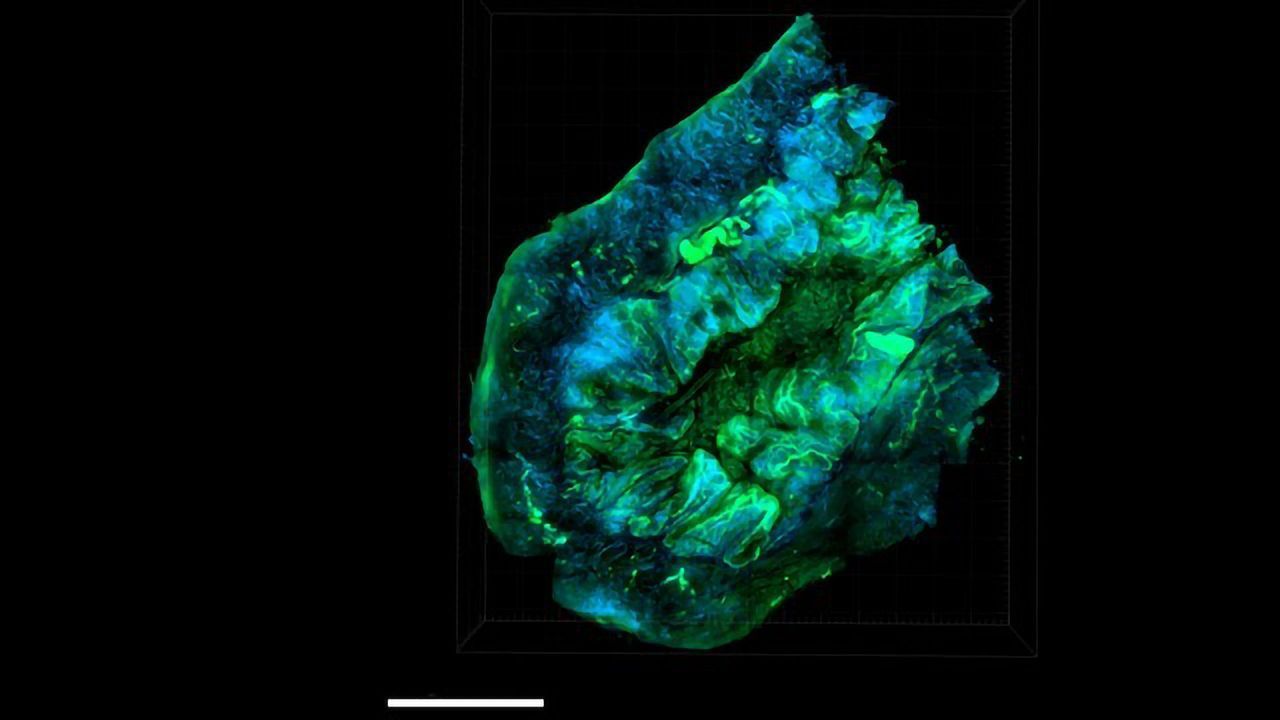 Uncovering Important Clues To Combat Ovarian Cancer