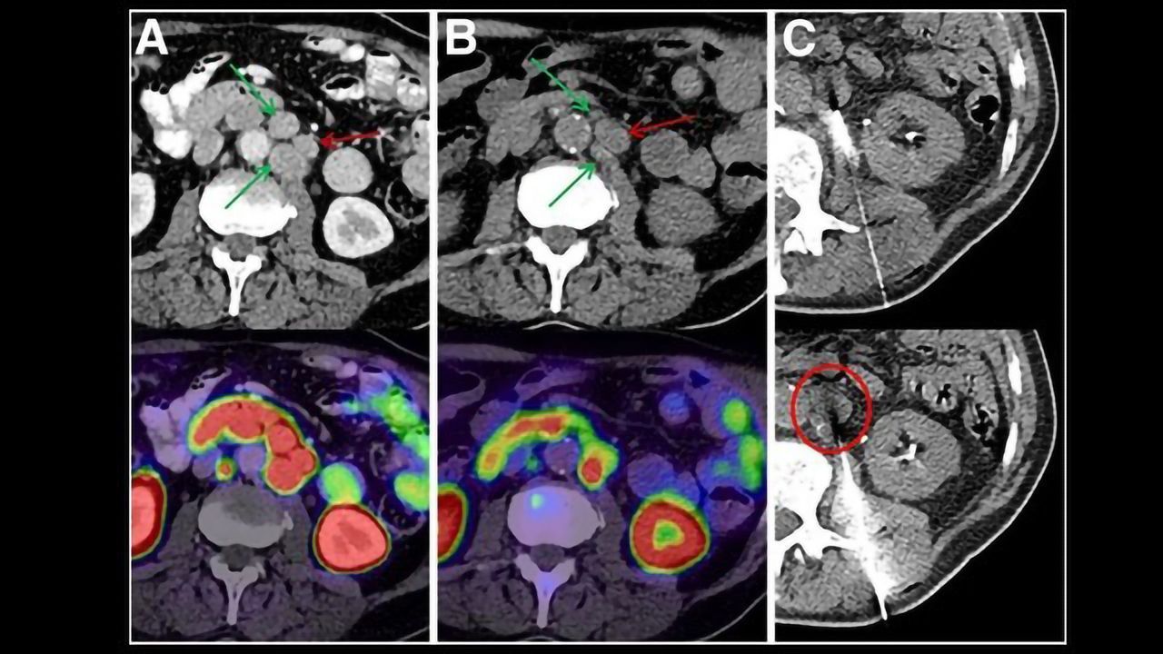 Potentially Treatable Mutations Discovered in Subset of Prostate Cancer Patients