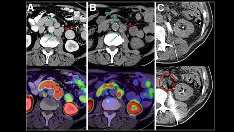 Potentially Treatable Mutations Discovered in Subset of Prostate Cancer Patients