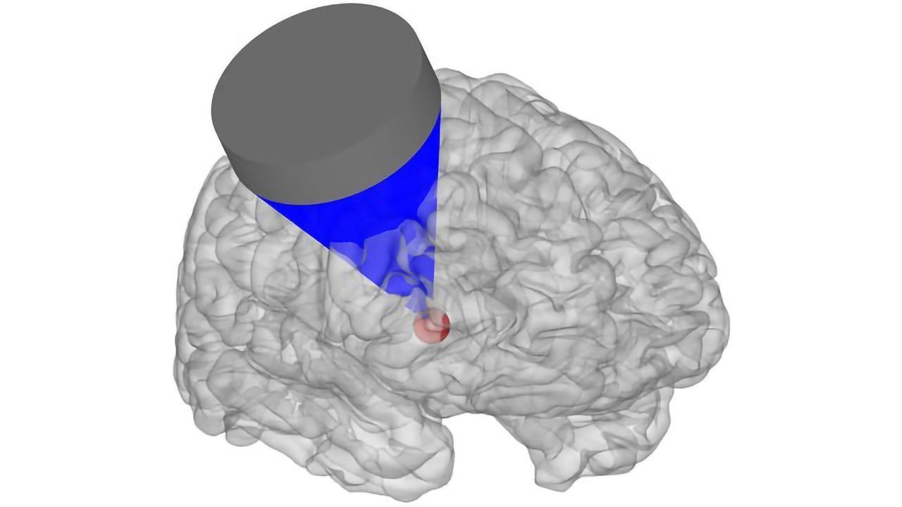 Ultrasound Waves Could Be Fired At the Brain for Mood-altering Precision Therapy