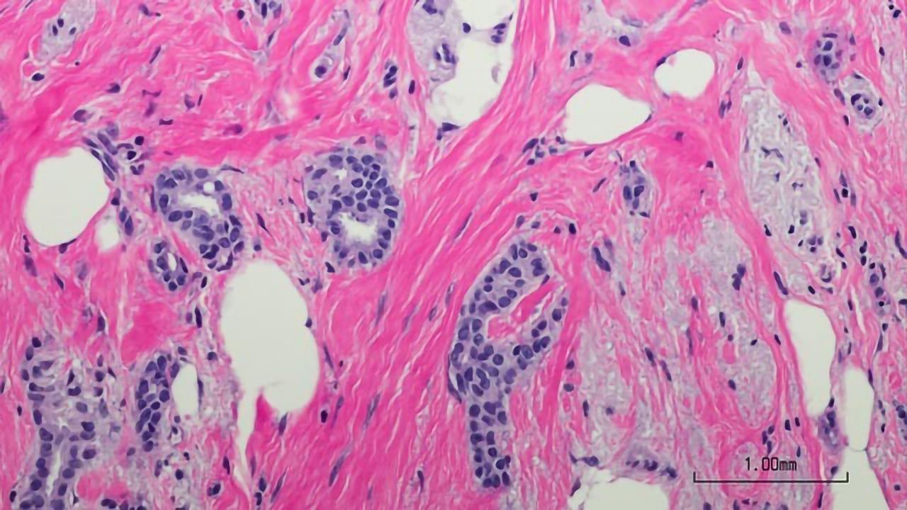 How Carcinogens Trigger Breast Cancer Development