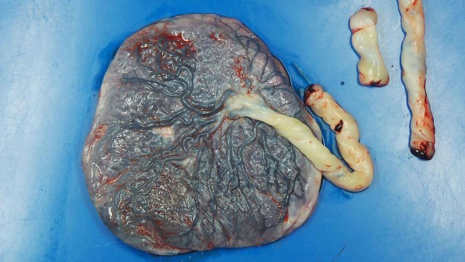 Findings From Small Study Suggest COVID-19 Could Cause Changes in the Placenta content piece image