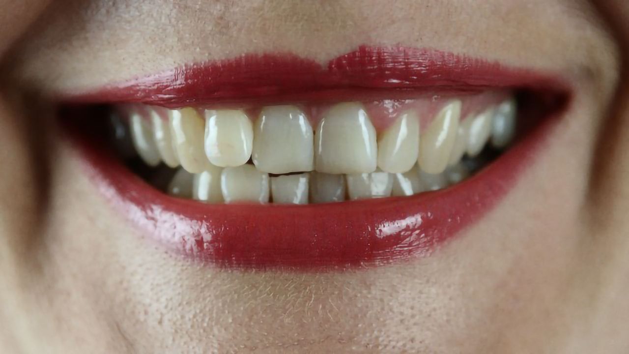 ALS Biomarkers Discovered in Teeth