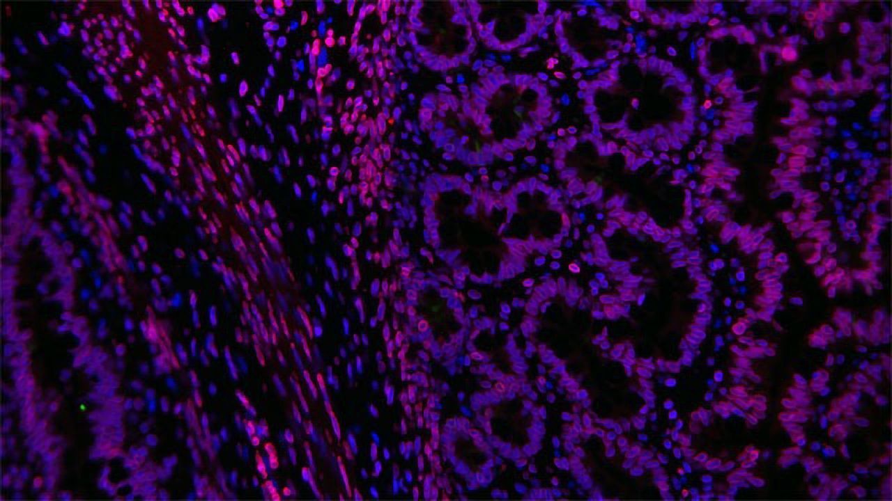 Preclinical Study Offers Hope for Hirschsprung's