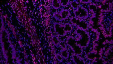 Preclinical Study Offers Hope for Hirschsprung's